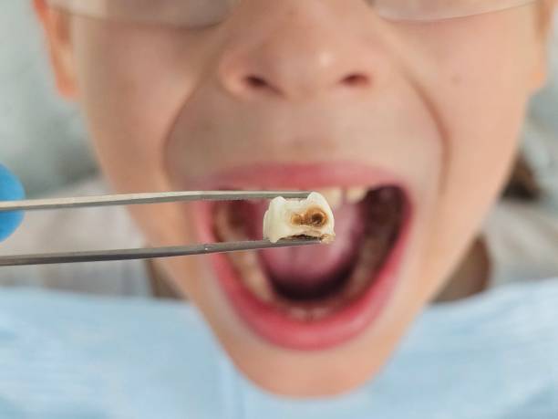 Best Emergency Dentist for Lost Fillings or Crowns in Westminster, SC